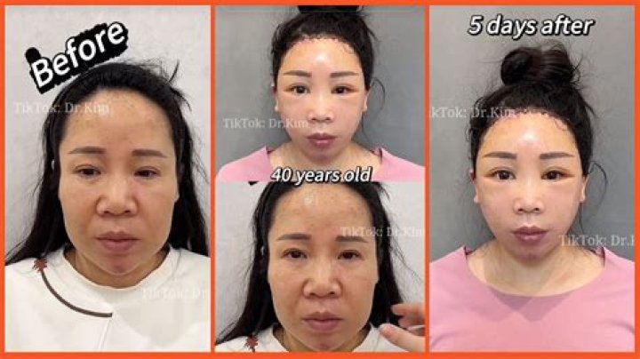 Bianca Censori's Plastic Surgery Journey