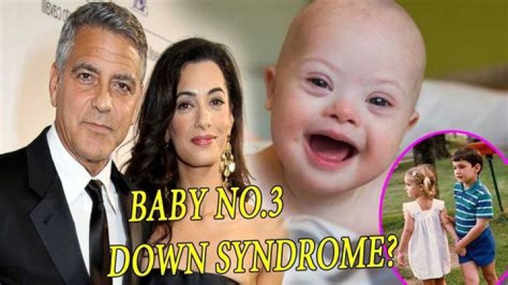 Down Syndrome And George Clooney's Son